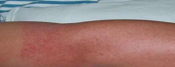 登革热疫情已蔓延至尼全国77个地区中的72个