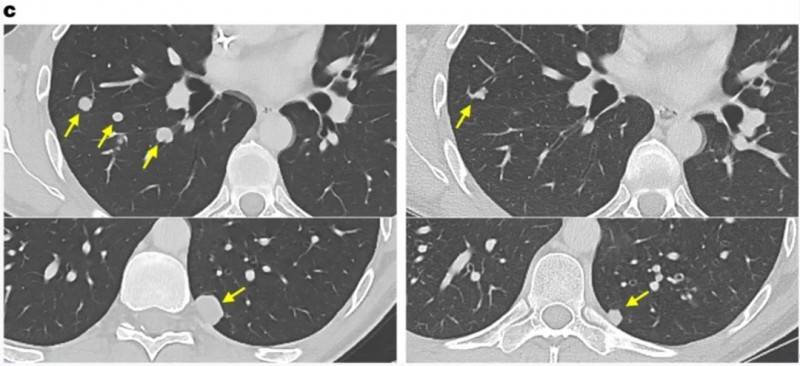贝达药业：泽弗利单抗联合巴替利单抗治疗晚期宫颈癌临床II期研究阶段