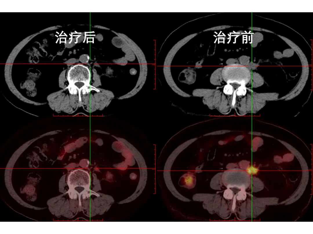 贝达药业：泽弗利单抗联合巴替利单抗治疗晚期宫颈癌临床II期研究阶段