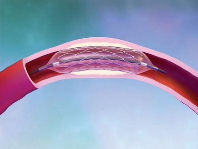 蓝帆医疗：参与国家组织冠状动脉药物涂层球囊集中带量采购拟中选