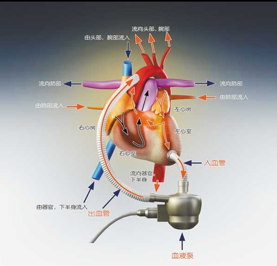 我国科研团队研发新技术开创“流体封堵”心脏介入治疗范式